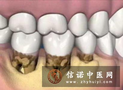 牙龈萎缩的表现有哪些？