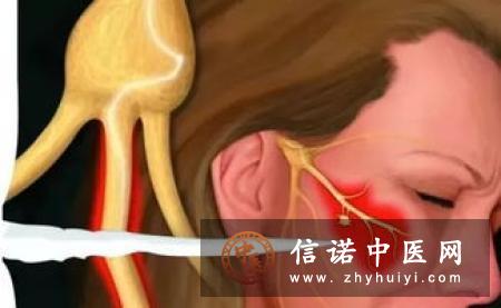 三叉神经疼的治疗中射频手术的效果和并发症