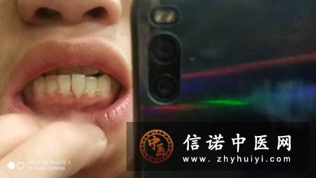牙龈发炎的治疗措施有哪些？