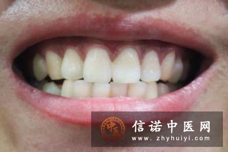 牙龈发炎的治疗措施有哪些？