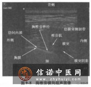 三叉神经节阻滞方法及并发症