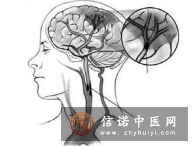 三叉神经第二支封闭疗法