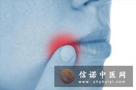 口腔溃疡不全是上火