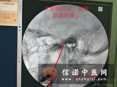 三叉神经痛的球囊压迫治疗原理和并发症