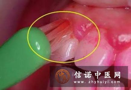 护理牙周炎有哪些方法呢？