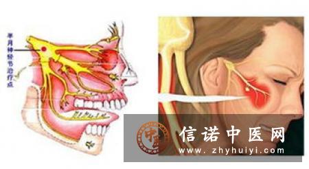 三叉神经第二支封闭疗法