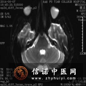 三叉神经节小神经丛的兴奋理论