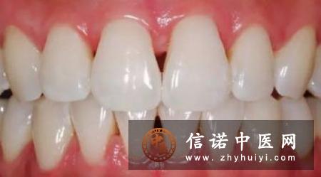 哪些因素影响黑三角的形成？