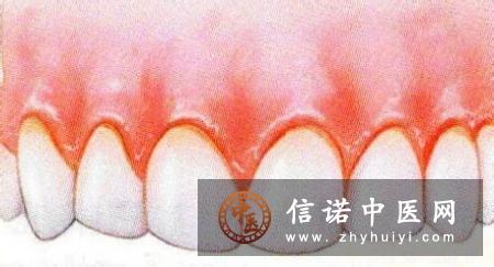 牙龈出血了是怎么回事