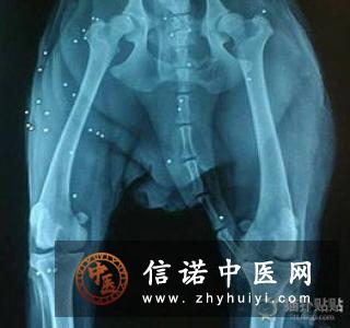 病理发射之下颌反射检查法