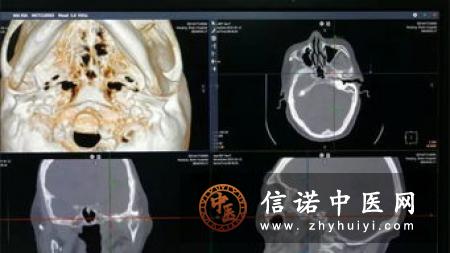 三叉神经痛的球囊压迫治疗原理和并发症
