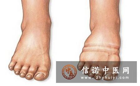 牙龈出血隐藏大问题