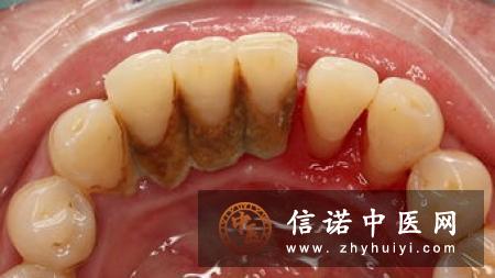牙龈炎的症状和治疗方法
